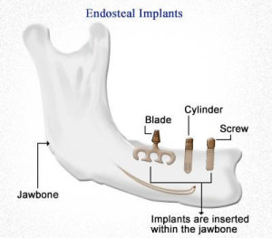 Endosseous-fog-implantatum