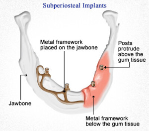 subperiosteal-fog-implantatum