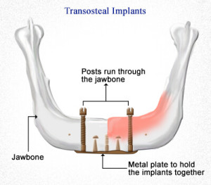 transosteal-fog-implantatum